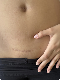 c-section scar recovery